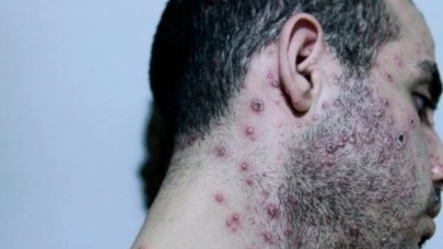 DSÖ’den maymun çiçeği salgını ile ilgili endişelendiren risk açıklaması