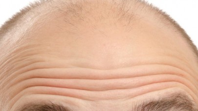 Kelliğe çözüm bulundu!