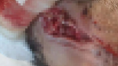 Küçükçekmecedeki pitbullu saldırı: Kulağını kaybetme ihtimali yüzde 90