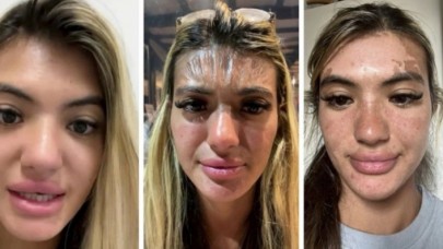 Güneşin altında uyuyakaldı, yüzü plastik gibi gerildi!