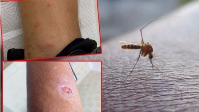 İstanbulda sivrisinek kabusu! Hastaneler dolup taştı, hedeflerinde iki kan grubu var