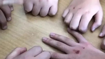 Hızla yaygınlaşıyor! Uzmanlardan kritik uyarı: Çocukların ellerinde kalıcı hasar bırakıyor