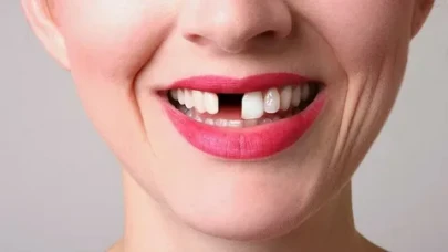 Diş kaybı yalnızca estetik bir sorun değil!