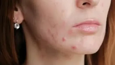 Akne oluşumuna yol açan 7 hata