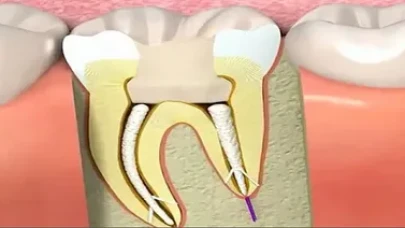Kanal tedavisi dişin ömrünü uzatıyor!