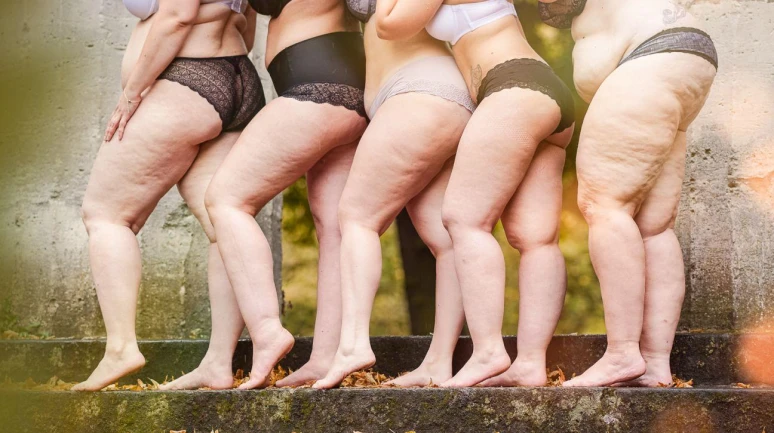 Lipödem varsa zayıflık yok!