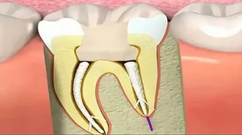 Kanal tedavisi dişin ömrünü uzatıyor!